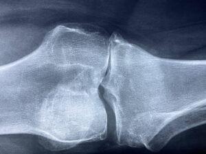 Endoproteza kolana – rehabilitacja, wskazania i powikłania